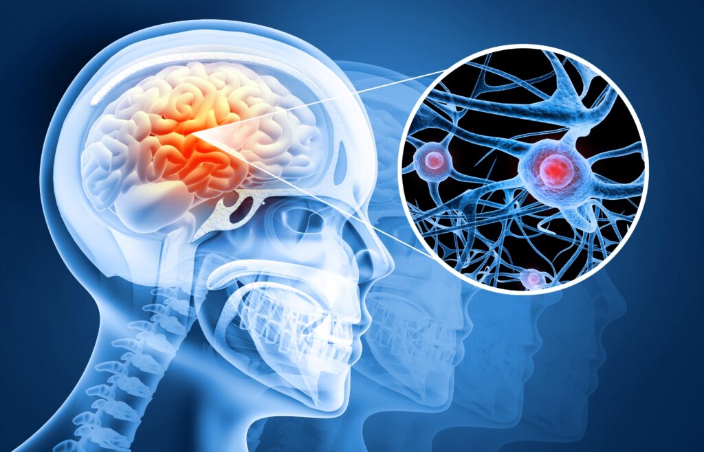 Types of Concussions